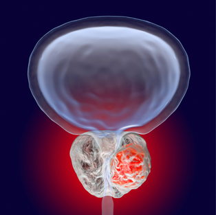 Câncer de próstata