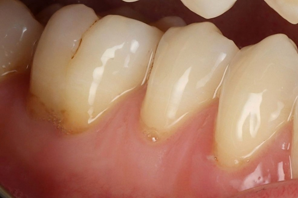 Collets exposés par une récession gingivale, cause fréquente de dents sensibles au froid