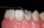 Restauration en composite stratifié direct sculpté en cabinet par le chirurgien-dentiste - finition manuelle au spatule