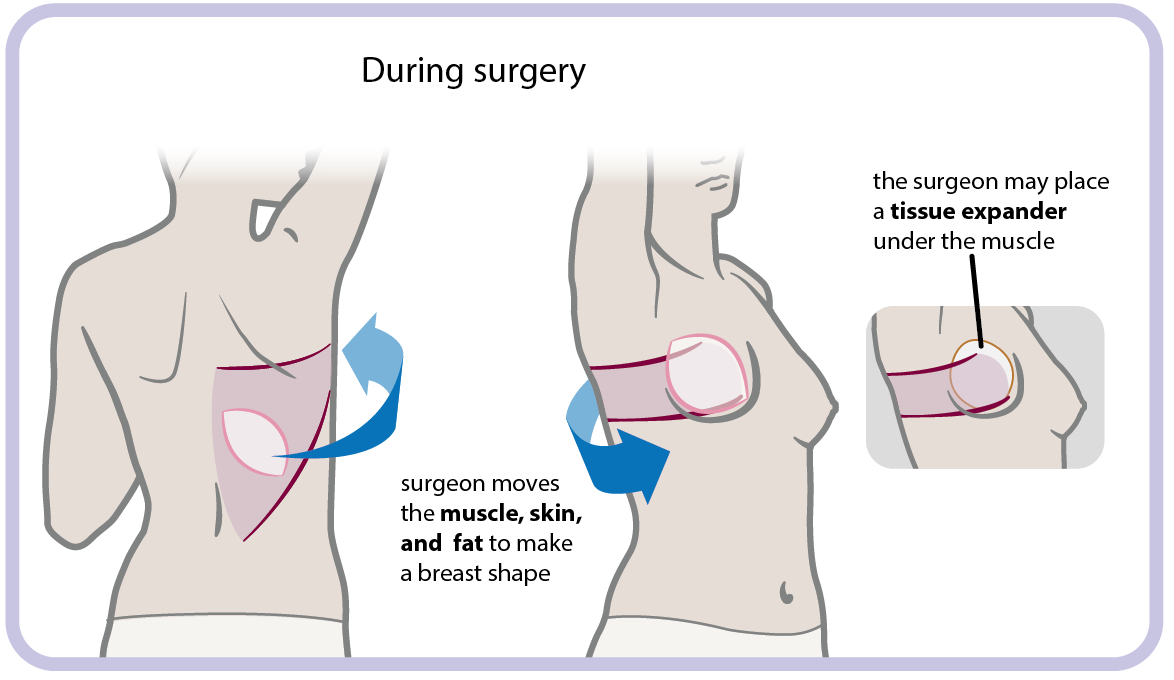 Lat flap during.png