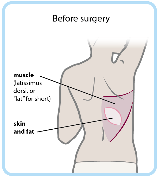 Lat flap before.png