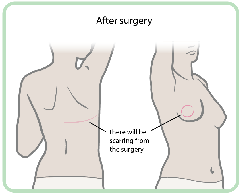Lat flap after.png