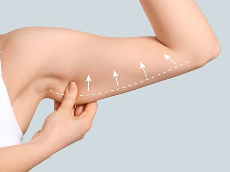 Arm Lift Surgery: Benefits, Procedure, and Recovery Explained