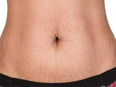 Why Is Stretch Marks Removal Popular?