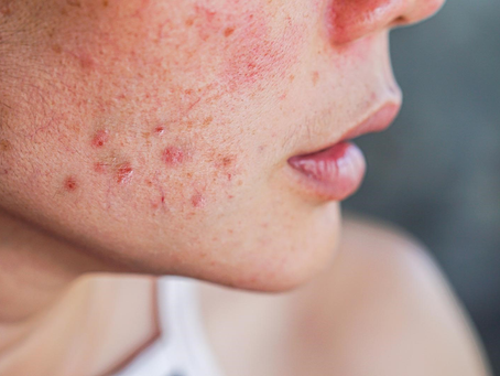 Acne Treatment for Hormonal Acne Made Simple