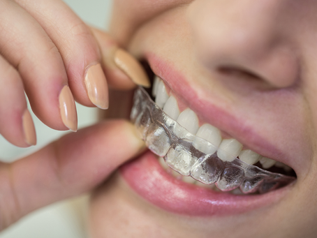 How Do Invisible Lingual Braces Move Roots?