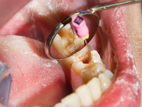 How Does a Root Canal Infection Develop?