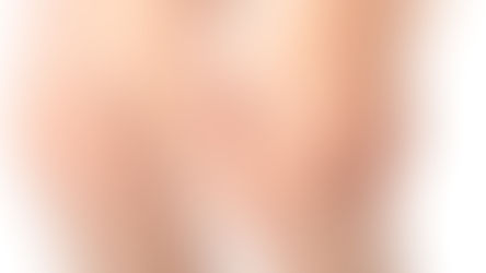 Lesión de meniscos / Resonancia Magnética