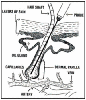 hair shaft picture showing electrolysis needle insertion for destruction of hair follicle