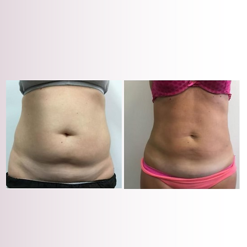 Lipo Laser with Whole Body Vibration and Full Body Infrared Detox (2).png