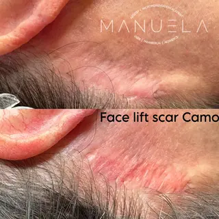 MANUELA, Face lift scar Camo before and after results.