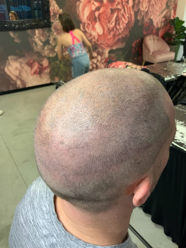 Scar Camouflage (FUE & FUT Repair) 5