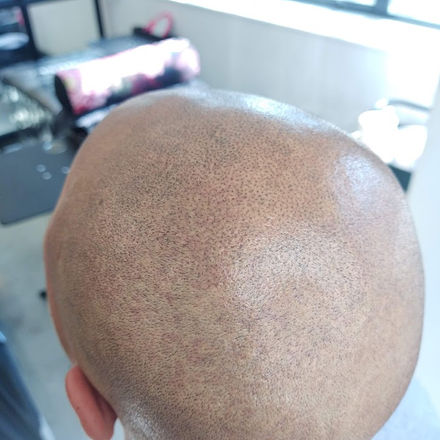 Male pattern baldness 3