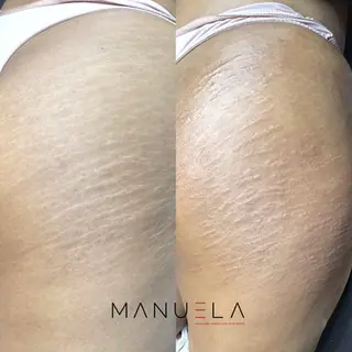 Before 7 after  stretch mark treatment results on skin -manuela-johannesburg