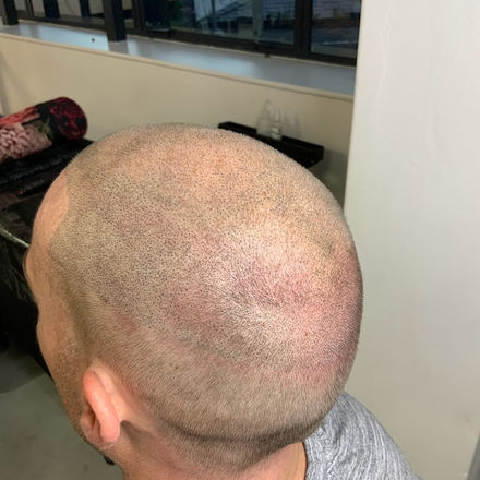 Scar Camouflage (FUE & FUT Repair) 3