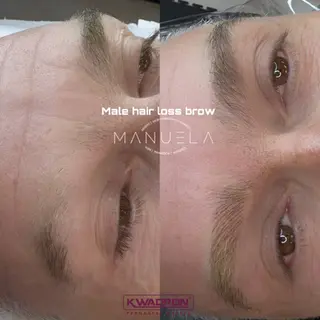 Male hair loss brow before after MANUELA  treatment.