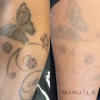 Dark butterfly tattoo on skin before and after by MANUELA removal.