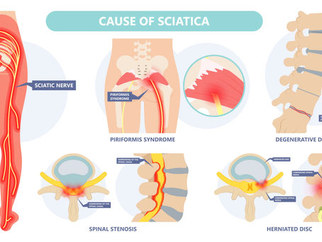 Sciatica