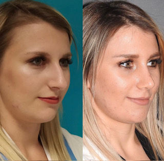 Rhinoplasty