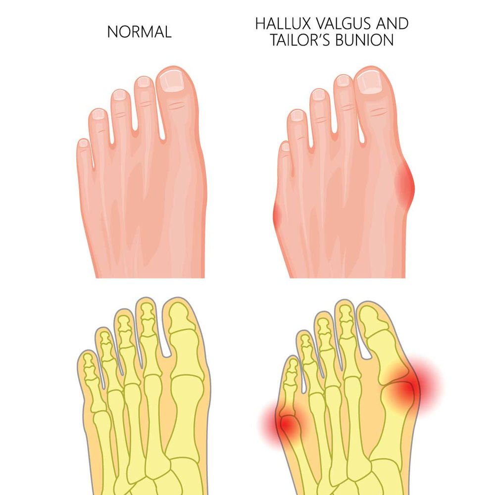 How To Treat Bunions (Hallux Valgus), (Tailor's Bunion)