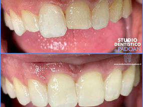 Denti abrasi,"consumati" e come risolvere