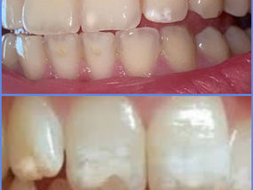 Le white spots, cioè le macchie bianche sui denti, cosa sono?