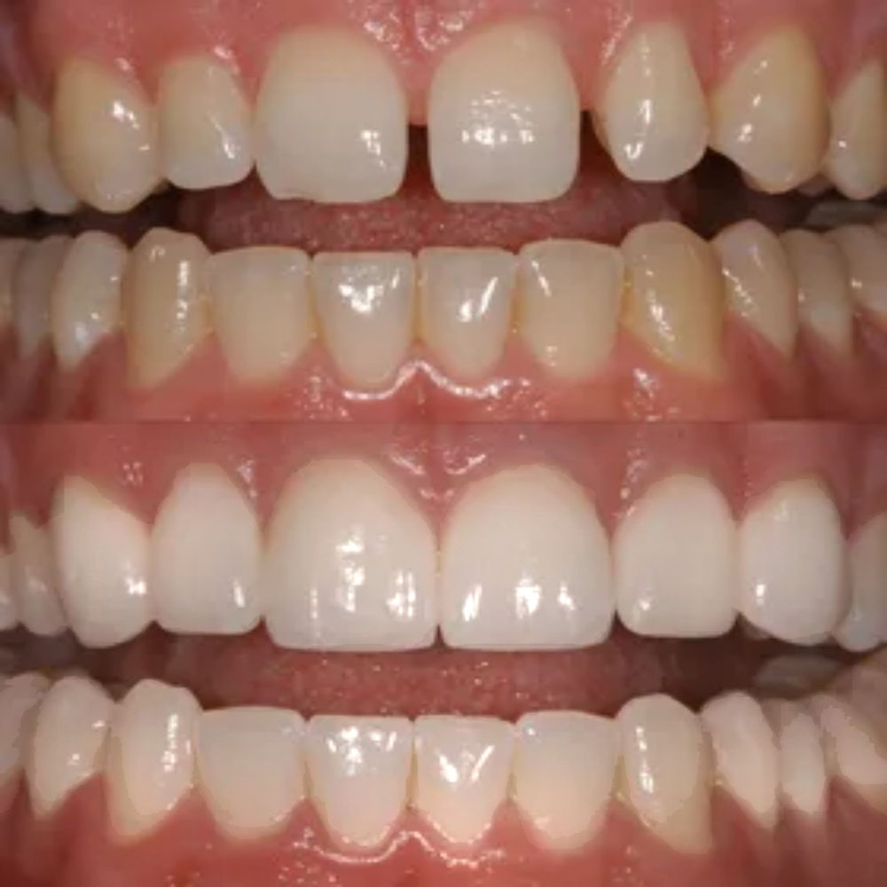 Cosa sono le Faccette Dentali? Cosa sono le Faccette Dentali?