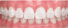 clear_braces.png