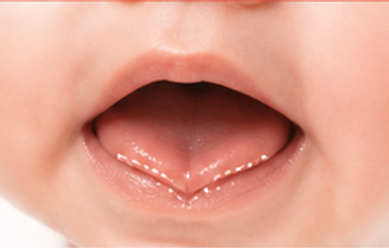 Tongue Tie