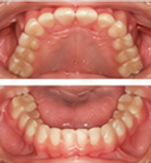 Invisalign_after_1.png