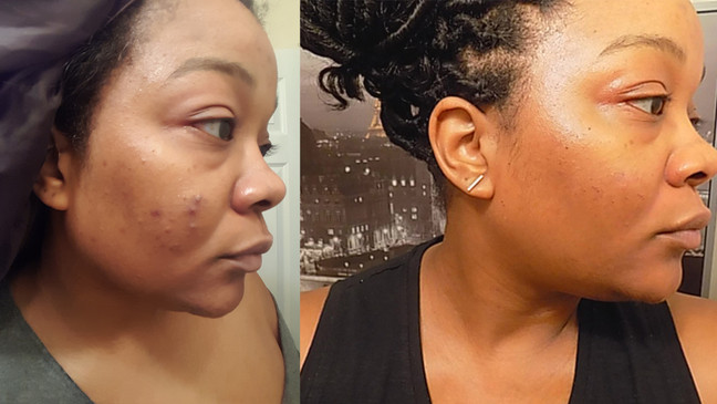 BANISH ACNE! A GUIDE TO CLEAR SKIN