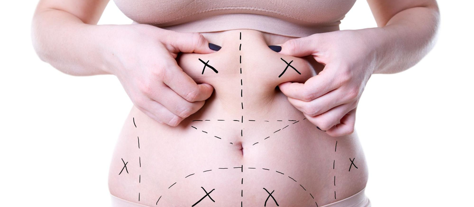 How Safe is Liposuction During Pregnancy?
