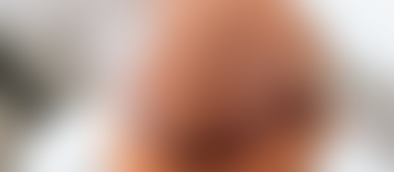 How to reduce shock loss post Hair Transplant?