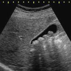 Colecistitis, Piedras en la vesicula biliar.