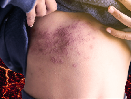 Personas con diabetes, población con riesgo de padecer herpes zóster y sus complicaciones.