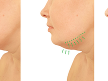 The Submental Reset: Sculpting the Neck Angle Without Surgery