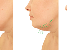 The Submental Reset: Sculpting the Neck Angle Without Surgery