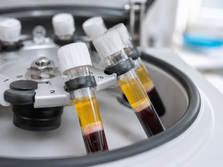 Liquid Gold: Rejuvenating Under-Eye Hollows with Autologous PRP