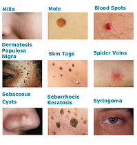 blemish removal.png