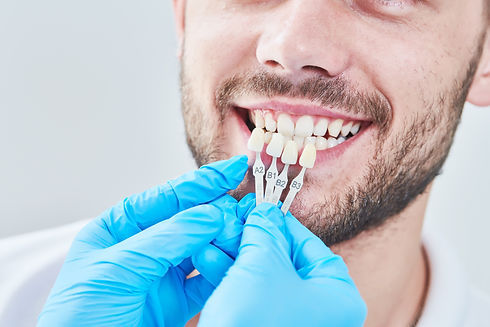 dentisterie : correspondance de la couleur de l'émail des dents avec le tableau de blanchi