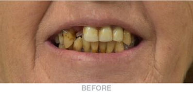 Complete-U-and-Partial-L-Denture-Before
