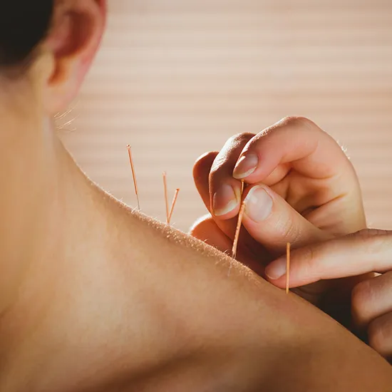 Acupuncture Treatment