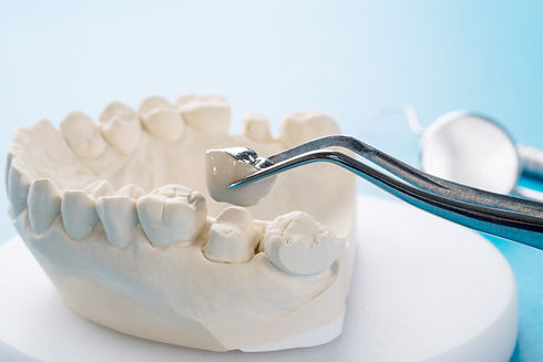 Close up Implan model tooth support fix bridge implan and crown.