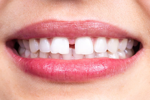 Diastème entre les dents