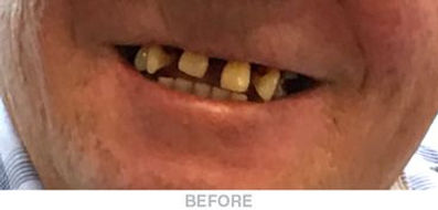 Complete-Upper-Surgical-Dentures-Before