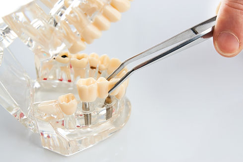 Technicien dentaire plaçant la prothèse partielle fixe, le pont dentaire sur les implants