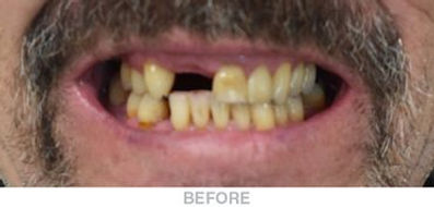 Complete-U-and-Partial-L-Denture-Before