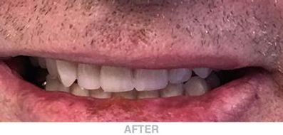 Complete-Upper-and-Lower-Surgical-After