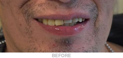 Complete-U-and-Partial-L-Denture-Before