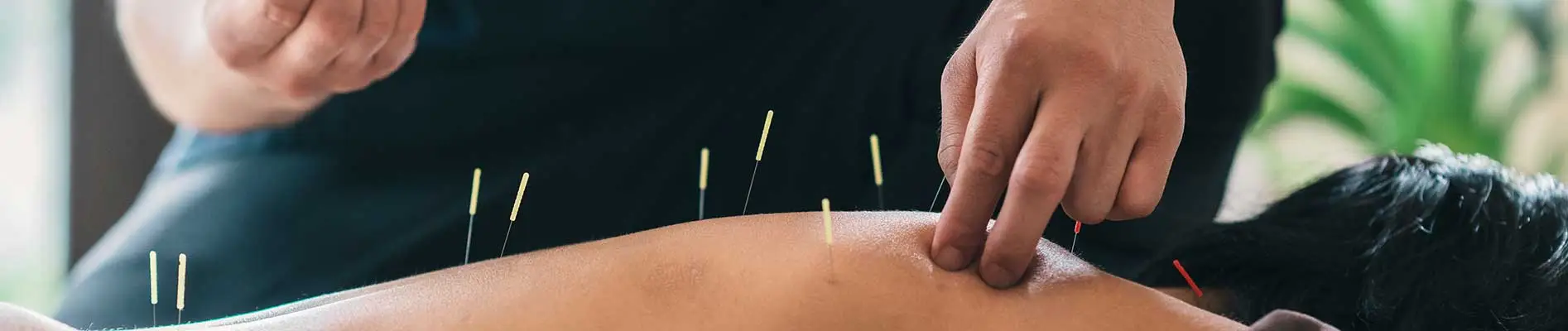 Acupuncture Therapy